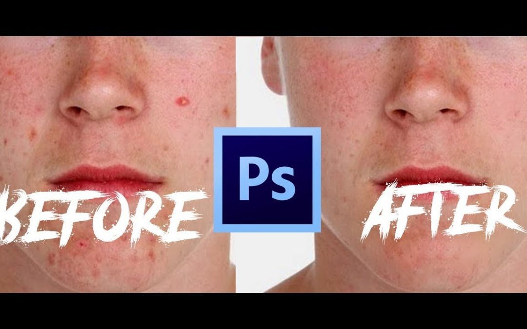 How To Remove Pimples With Only One Tool In Adobe Photoshop! Tutorial