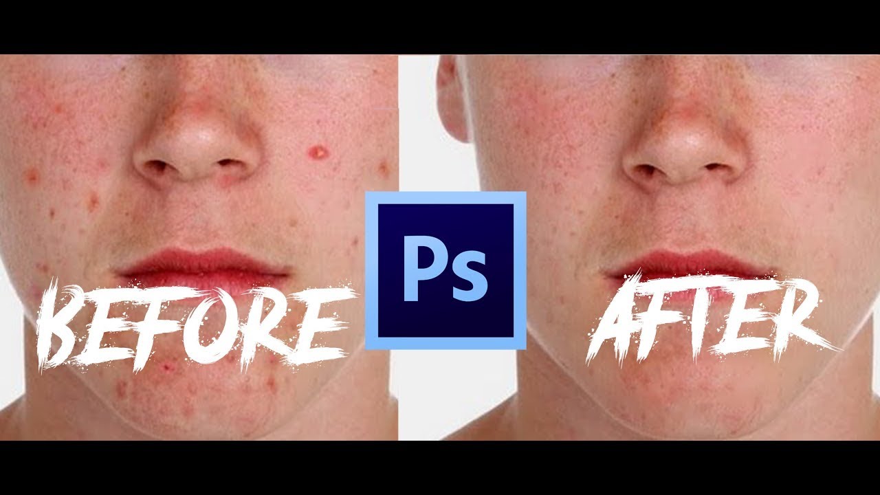 How To Remove Pimples With Only One Tool In Adobe Photoshop! Tutorial